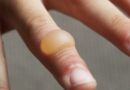 How long does it take a burn blister to heal?
