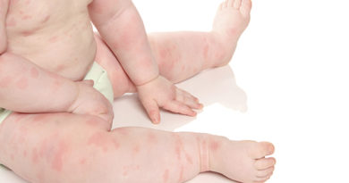 What causes rash on toddlers body?